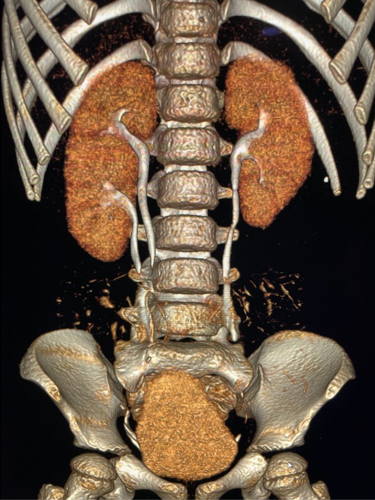 Reconstrucción 3D de tomografía renal