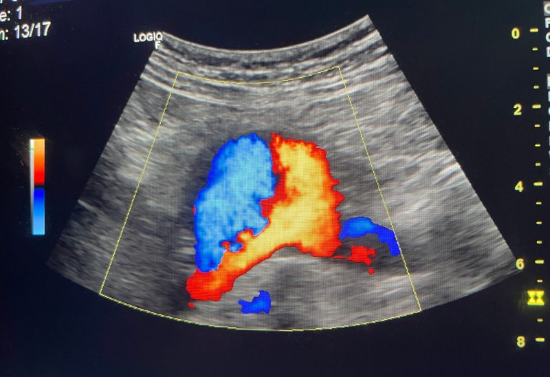 Ultrasonido Doppler