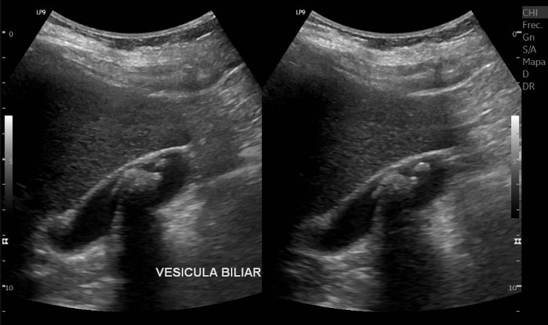 Ultrasonido de vesícula biliar