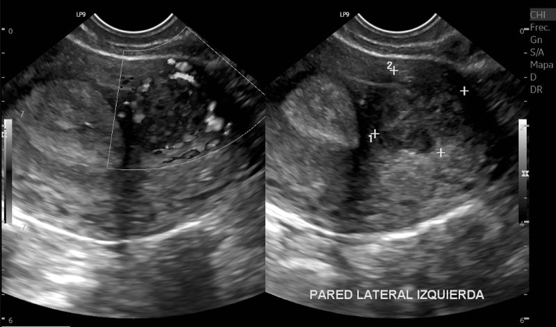 Ultrasonido endovaginal, ovario