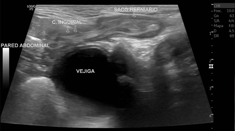 Ultrasonido pélvico, cavidad endometrial