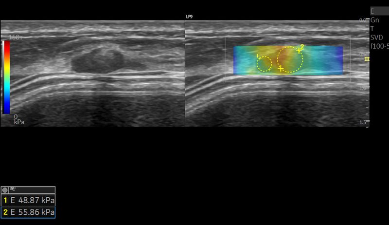 Ultrasonido mamario, calcificación