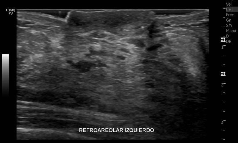Ultrasonido de implante mamario