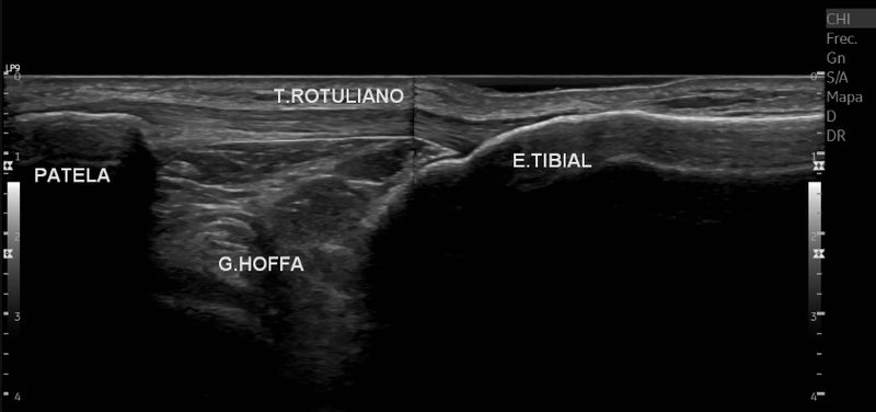 Ultrasonido musculoesquelético de rodilla
