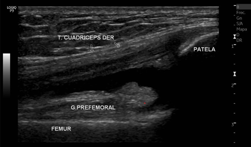 Ultrasonido musculoesquelético de rodilla